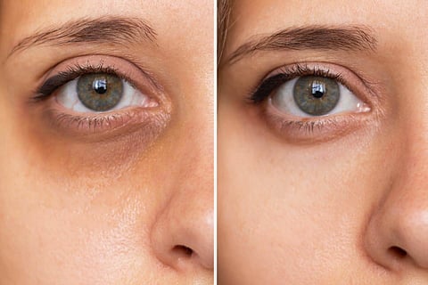 dark circles