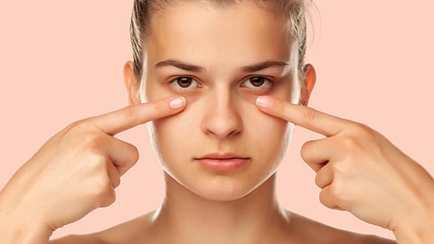 eyes-dark-circles