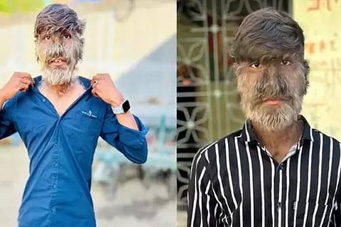 Werewolf Syndrome