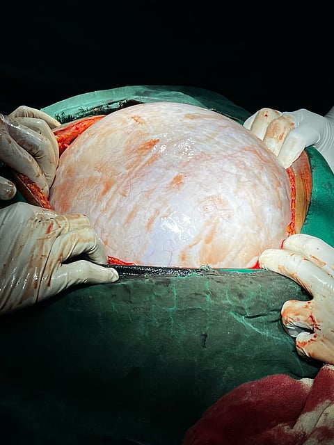 Woman has 13 kg tumor in her stomach Mandya