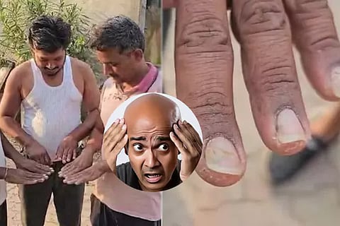 Nail Loss