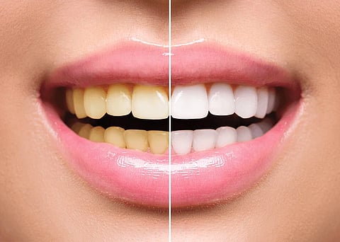woman-teeth-before-after-whitening-600nw-446773795
