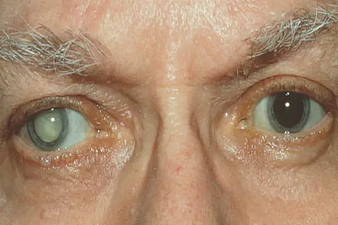 Cataract