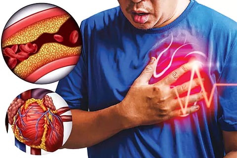 Heart Attack