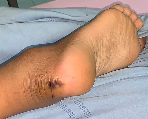 snake bite