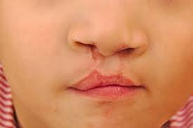 Clift lip