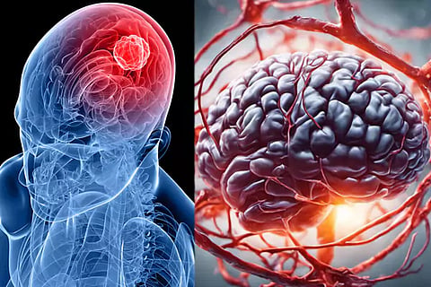 Brain Tumor