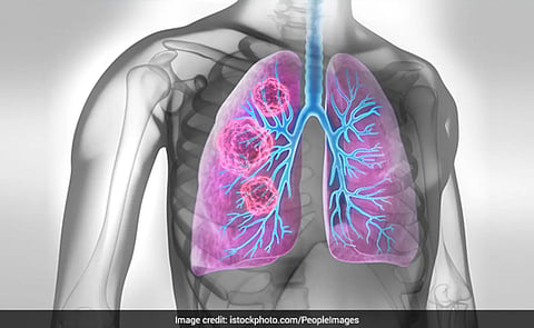 Lung cancer day - 1