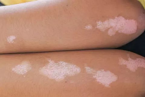White Spots