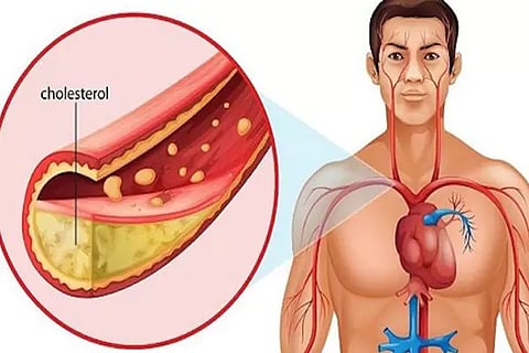 Dirty Cholesterol