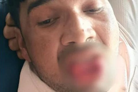 ನಾಲಿಗೆ ಕಚ್ಚಿಸಿಕೊಂಡ ಚಂಪಿ ಎಂಬ ವ್ಯಕ್ತಿ