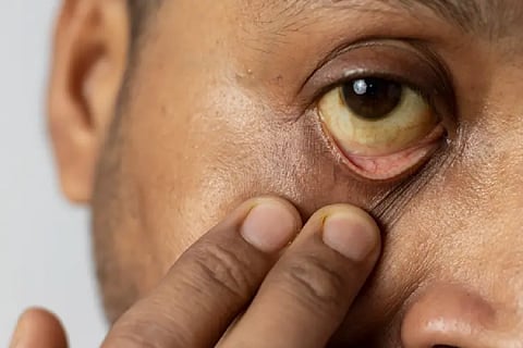 Fatty liver symptoms in eyes