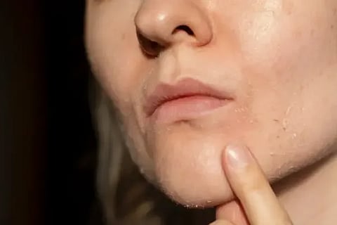 Skin Drying