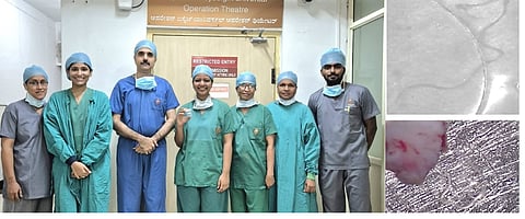 ಬಾಲಕಿಯ ಕಣ್ಣಿನೊಳಗಿದ್ದ ಜೀವಂತ ಪರಾವಲಂಬಿ ಹುಳುವನ್ನು ಶಸ್ತ್ರ ಚಿಕಿತ್ಸೆ ಮೂಲಕ ಹೊರತೆಗೆದ ಕೆಎಂಸಿಯ ಡಾ. ಯೋಗೀಶ್​ ಎಸ್​. ಕಾಮತ್​ ಹಾಗೂ ವೈದ್ಯರ ತಂಡ. ಕಣ್ಣಿನಿಂದ ಹೊರ ತೆಗೆದ ದಾರದ ಮಾದರಿಯ ಪರಾವಲಂಬಿ ಹುಳು. (ಬಲಭಾಗದ ಚಿತ್ರ).
