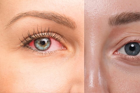  Conjunctivitis eyes during monsoon