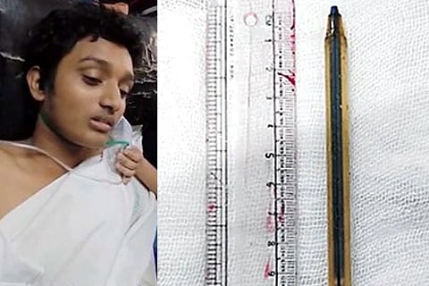 ಕೇವಲ 50 ರೂ. ಆಸೆಗೆ ಪೆನ್​ ನುಂಗಿದ ವಿದ್ಯಾರ್ಥಿ