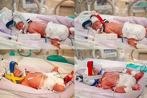 Quadruplet birth Australia (ಚಿತ್ರ X)
