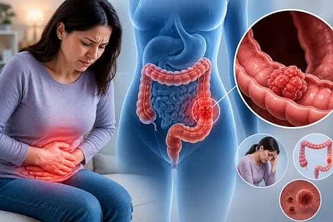 Colon Cancer In Women ಸಾಂದರ್ಭಿಕ ಚಿತ್ರ