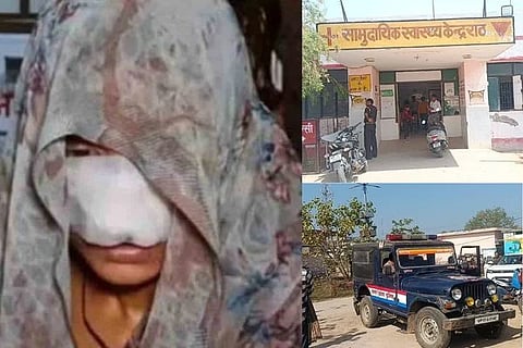 ಪತ್ನಿಯ ಮೂಗು ಮತ್ತು ಗಲ್ಲವನ್ನು ಕಚ್ಚಿ ಪರಾರಿಯಾದ ಪತಿರಾಯ
