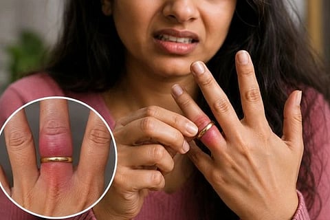 Ring Stuck On Finger ಸಾಂದರ್ಭಿಕ ಚಿತ್ರ