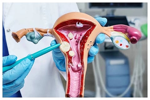 Uterine Fibroids
