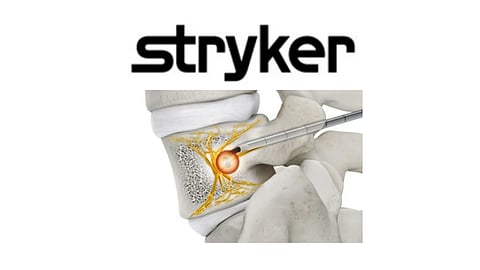 Stryker’s OptaBlate BVN System Receives FDA Clearance, Offering Minimally Invasive Relief for Chronic Vertebrogenic Back Pain