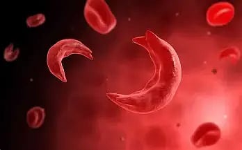 Government Slashes Cost of Sickle Cell Anaemia Tests to Under ₹50 to Boost Nationwide Screening
