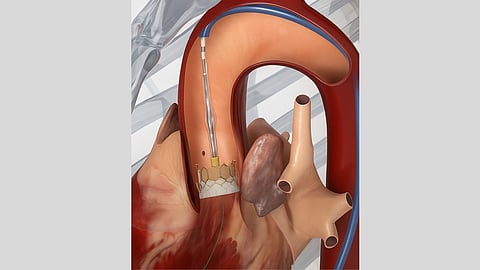 EDWARDS LIFESCIENCES Launches Next-Generation Transcatheter Heart Valve in INDIA, offering durable, minimally invasive treatment for Aortic Stenosis
