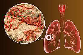 WHO Issues New Global Guidelines Integrating Nutrition into Tuberculosis (TB) Care and Prevention