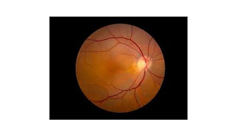 Tiny Retinal Implant Restores Sight in Advanced Age-Related Macular Degeneration, Study Shows