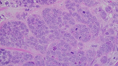 MHRA Approves Inavolisib For PIK3CA-Mutant Breast Cancer