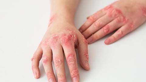Stapokibart Proven Effective In Kids With Atopic Dermatitis