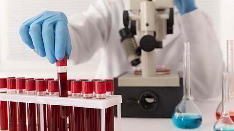 Blood-Based Biomarkers Identified By Tezpur University Researchers Could Aid Early Gallbladder Cancer Diagnosis