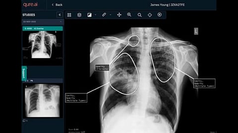 Qure.ai Wins Gates Foundation Grant To Advance AI Diagnostics For TB & Pneumonia Worldwide