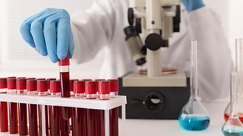 Researchers Develop Four-Marker Blood Test For Earlier Detection Of Pancreatic Cancer