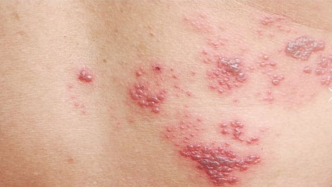 Shingles Disrupts Life, Yet Half Of Ageing Indians With Chronic Conditions Don’t Talk About Prevention With Doctors: GSK Study